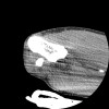 SPORK, NICO - 22.03.1976 - 02.08.2022 - CT obere Extremität - 17:51:17